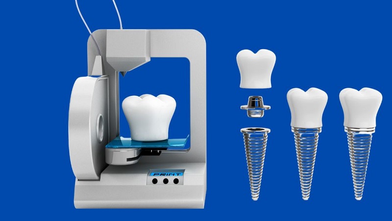 بهترین ایمپلنت اصفهان | تأثیر چاپ سه‌بعدی بر طراحی و ساخت ایمپلنت‌ | بهترین دندانپزشک زیبایی اصفهان | دکتر ندا مکانیک