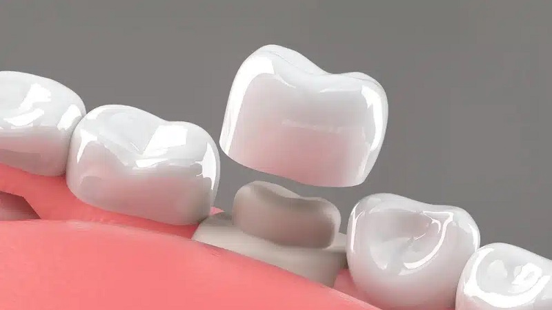 ماندگاری چسب‌های رزینی روکش دندان | بهترین ایمپلنت اصفهان | بهترین دندانپزشک زیبایی اصفهان | دکتر ندا مکانیک