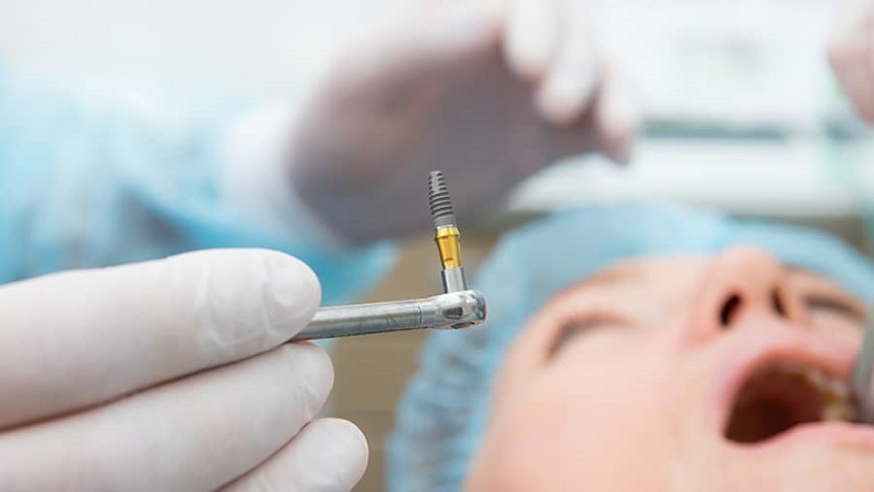 بهترین ایمپلنت اصفهان | مقایسه دقت روش های جراحی ایمپلنت دندان | بهترین ایمپلنت اصفهان | دکتر ندا مکانیک