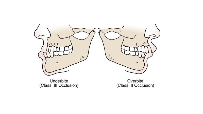 مقایسه روش‌های درمان آندربایت حاد | بهترین دندانپزشک زیبایی اصفهان | دکتر ندا مکانیک