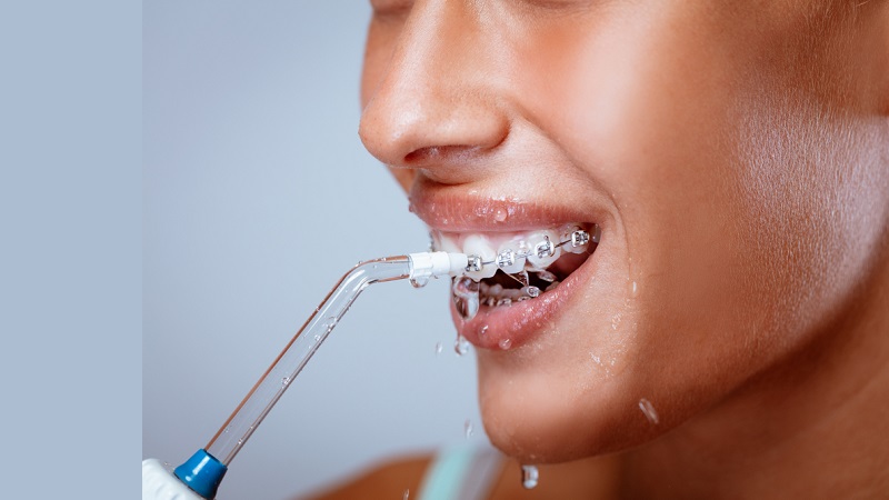 بهترین ایمپلنت اصفهان | کارایی و محدودیت‌ جرم‌گیری با فشار آب در حفظ سلامت لثه بیماران ارتودنسی | بهترین دندانپزشک زیبایی اصفهان | دکتر ندا مکانیک