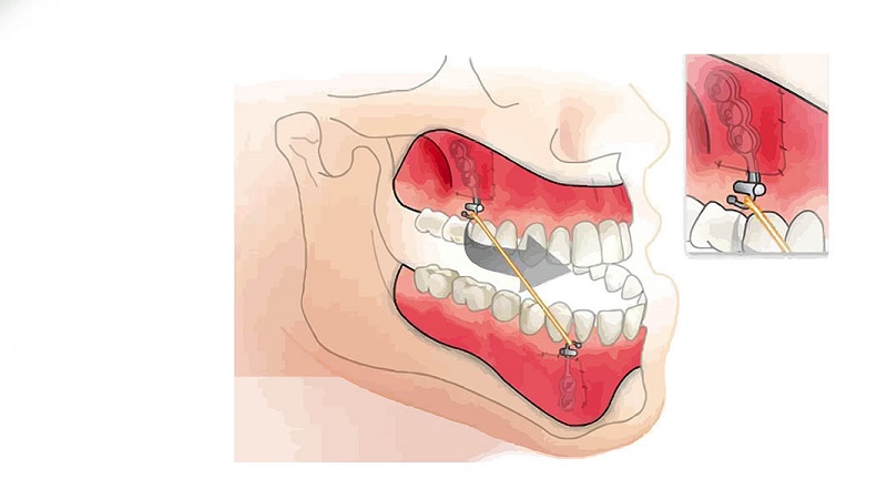بهترین ایمپلنت اصفهان | کاربرد مینی‌پلیت‌ها در دندانپزشکی زیبایی | بهترین دندانپزشک زیبایی اصفهان | دکتر ندا مکانیک