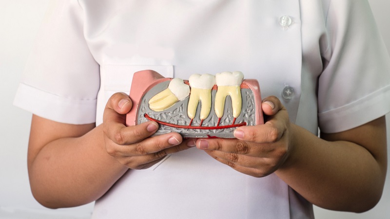 کشیدن یا نگهداشتن دندان‌های عقل | بهترین دندانپزشک اصفهان | دکتر ندا مکانیک