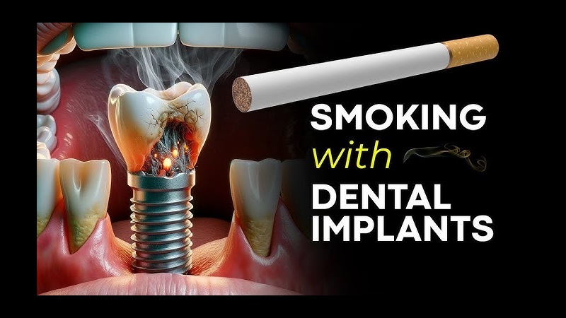 ایمپلنت در بیماران سیگاری یا با عادات خاص | بهترین ایمپلنت اصفهان | دکتر ندا مکانیک