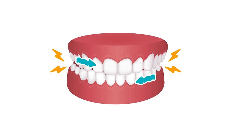 بهترین ایمپلنت اصفهان | بهترین دندانپزشک زیبایی اصفهان | دکتر مکانیک | بهترین دندانپزشک اصفهان | بهترین دندانپزشک کودکان اصفهان | تأثیر ترک‌های ناخودآگاه بر ماندگاری روکش و لمینت| دکتر ندا مکانیک