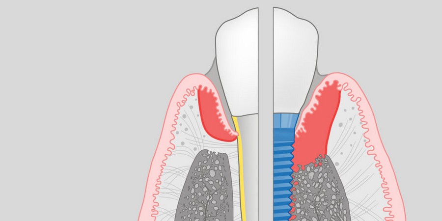بهترین دندانپزشک زیبایی اصفهان | دکتر مکانیک | بهترین دندانپزشک اصفهان | بهترین دندانپزشک کودکان اصفهان | رویکردهای نوین در پیشگیری التهاب‌های اطراف ایمپلنت |دکتر ندا مکانیک