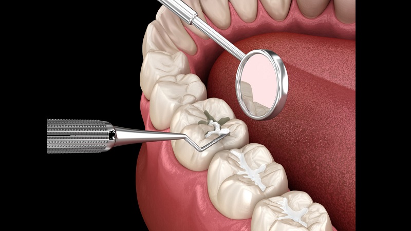 مقایسه انواع مواد پرکننده در ترمیم دندان شیری | بهترین دندانپزشک زیبایی اصفهان | دکتر ندا مکانیک