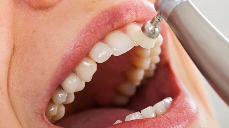 نقش میکروابریژن در حذف لکه‌های ژنتیکی و فلئوروزیس | بهترین ایمپلنت اصفهان | بهترین دندانپزشک زیبایی اصفهان | دکتر ندا مکانیک