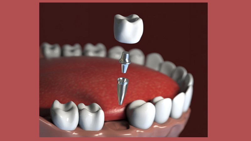 بهترین دندانپزشک زیبایی اصفهان | دکتر مکانیک | بهترین دندانپزشک اصفهان | بهترین دندانپزشک کودکان اصفهان | دکتر ندا مکانیک | کاربرد ایمپلنت‌های دندانی سبک‌وزن در فک‌های ضعیف