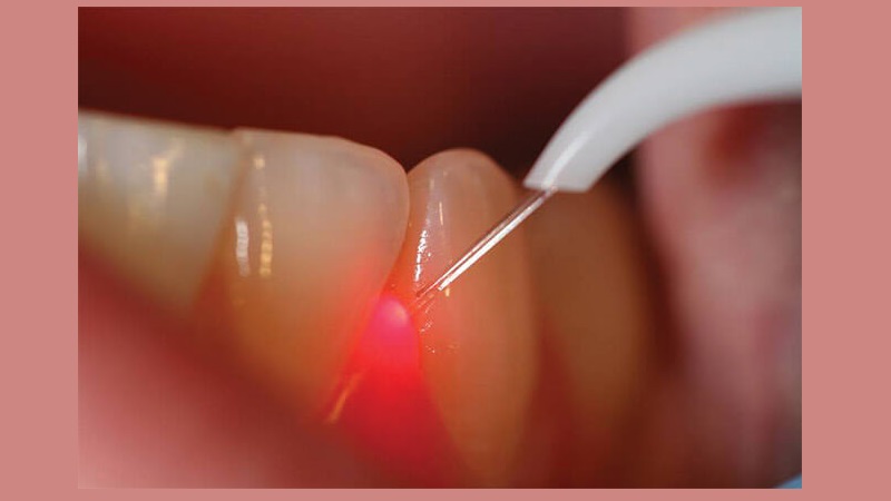 بهترین ایمپلنت اصفهان | کاربرد لیزر در درمان‌های دندان‌پزشکی مدرن | بهترین دندانپزشک اصفهان | دکتر ندا مکانیک