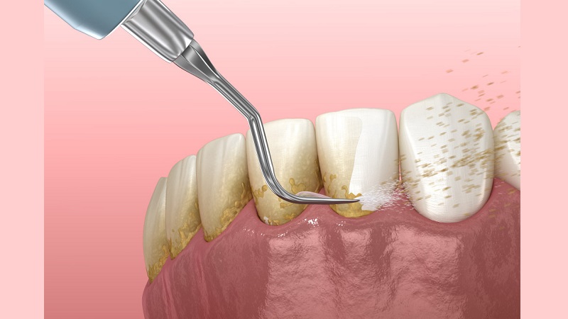 آیا جرم گیری ضرر داره؟ | بهترین ایمپلنت اصفهان | بهترین دندانپزشک زیبایی اصفهان | دکتر مکانیک | بهترین دندانپزشک اصفهان | بهترین دندانپزشک کودکان اصفهان | دکتر ندا مکانیک