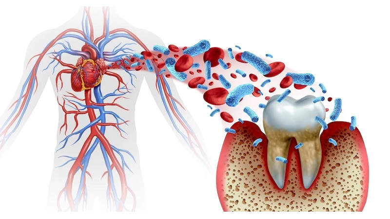 ارتباط سلامت دهان با بیماری‌های قلبی | بهترین دندانپزشک زیبایی اصفهان | دکتر مکانیک | بهترین دندانپزشک اصفهان | بهترین دندانپزشک کودکان اصفهان | دکتر ندا مکانیک