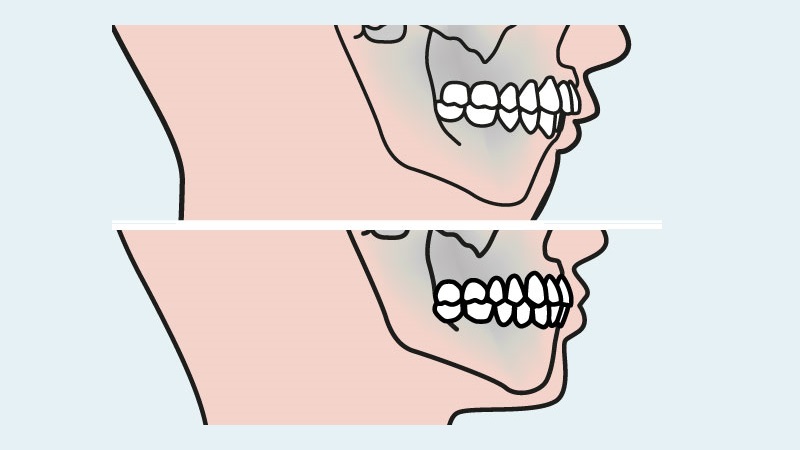 ارزیابی و تشخیص زودهنگام مال‌اکلوژن اسکلتی در کودکان | بهترین دندانپزشک زیبایی اصفهان | دکتر ندا مکانیک