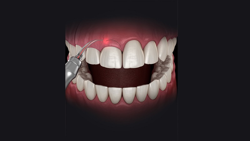 اصلاح خط لثه با روش‌های لیزردرمانی | بهترین دندانپزشک زیبایی اصفهان | دکتر مکانیک | بهترین دندانپزشک اصفهان | بهترین دندانپزشک کودکان اصفهان | دکتر ندا مکانیک