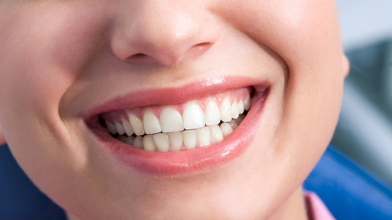 اصلاح لبخند در بیماران دچار سایش دندانی | بهترین دندانپزشک زیبایی اصفهان | دکتر ندا مکانیک