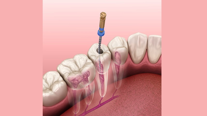 باورهای غلط در رابطه با عصب کشی دندان | بهترین دندانپزشک اصفهان | دکتر ندا مکانیک