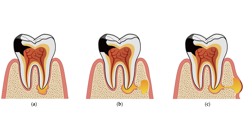 تشخیص و درمان ضایعات پری‌اپیکال در دندان‌های شیری | بهترین دندانپزشک کودکان اصفهان | دکتر ندا مکانیک
