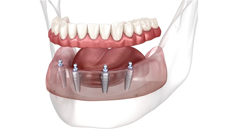 جایگزین‌های موقت برای ایمپلنت دندان | بهترین دندانپزشک زیبایی اصفهان | دکتر مکانیک | بهترین دندانپزشک اصفهان | بهترین دندانپزشک کودکان اصفهان | دکتر ندا مکانیک