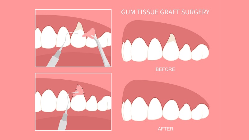 بهترین ایمپلنت اصفهان | بهترین دندانپزشک زیبایی اصفهان | دکتر مکانیک | بهترین دندانپزشک اصفهان | بهترین دندانپزشک کودکان اصفهان | زمان نیاز به جراحی لثه | دکتر ندا مکانیک