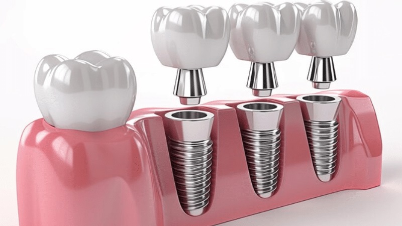 بهترین ایمپلنت اصفهان | بهترین دندانپزشک زیبایی اصفهان | دکتر مکانیک | بهترین دندانپزشک اصفهان | بهترین دندانپزشک کودکان اصفهان | طول عمر ایمپلنت دندان چقدر است؟ |