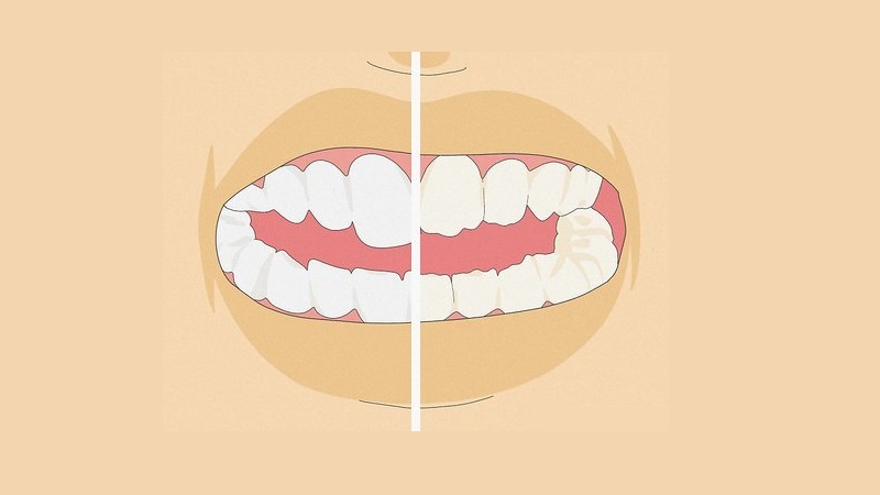 علل سایش مینای دندان در کودکان | بهترین دندانپزشک کودکان اصفهان | دکتر ندا مکانیک