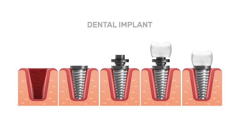 قبل از تصمیم به کاشت ایمپلنت دندان | بهترین دندانپزشک زیبایی اصفهان | دکتر مکانیک | بهترین دندانپزشک اصفهان | بهترین دندانپزشک کودکان اصفهان | دکتر ندا مکانیک