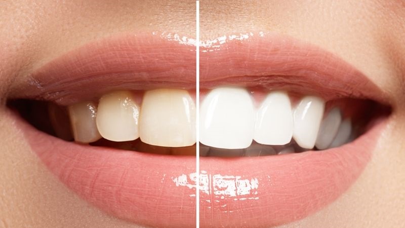 محدودیت‌های استفاده از محصولات سفید کننده دندان خانگی | بهترین دندانپزشک زیبایی اصفهان | دکتر مکانیک | بهترین دندانپزشک اصفهان | بهترین دندانپزشک کودکان اصفهان | دکتر ندا مکانیک