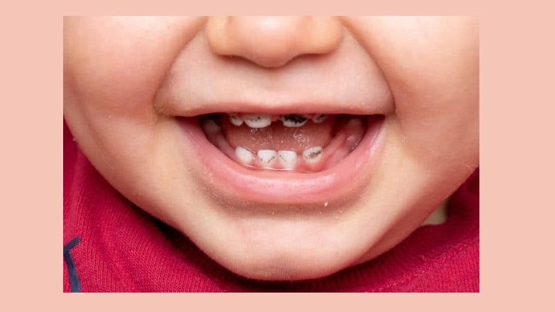 مدیریت بالینی پوسیدگی زودرس دوران کودکی | بهترین دندانپزشک کودکان اصفهان | دکتر ندا مکانیک