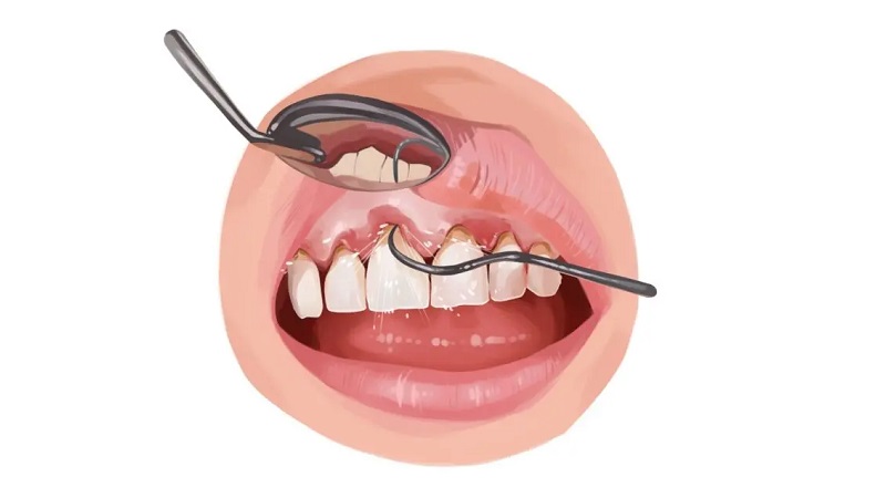 بهترین ایمپلنت اصفهان | بهترین دندانپزشک زیبایی اصفهان | دکتر مکانیک | بهترین دندانپزشک اصفهان | بهترین دندانپزشک کودکان اصفهان | مقایسه جرم‌گیری لثه و جراحی لثه | دکتر ندا مکانیک