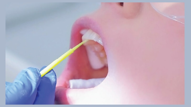 نقش فلوراید در پیشگیری از پوسیدگی | بهترین دندانپزشک اصفهان | دکتر ندا مکانیک