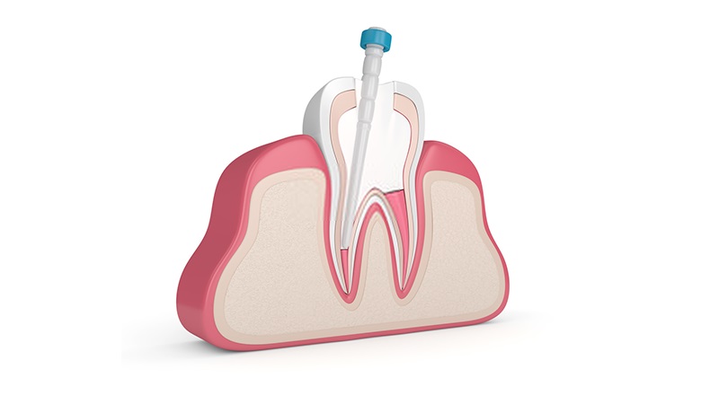 پروتکل‌های پالپ‌درمانی در دندان‌های شیری | بهترین دندانپزشک کودکان اصفهان | دکتر ندا مکانیک