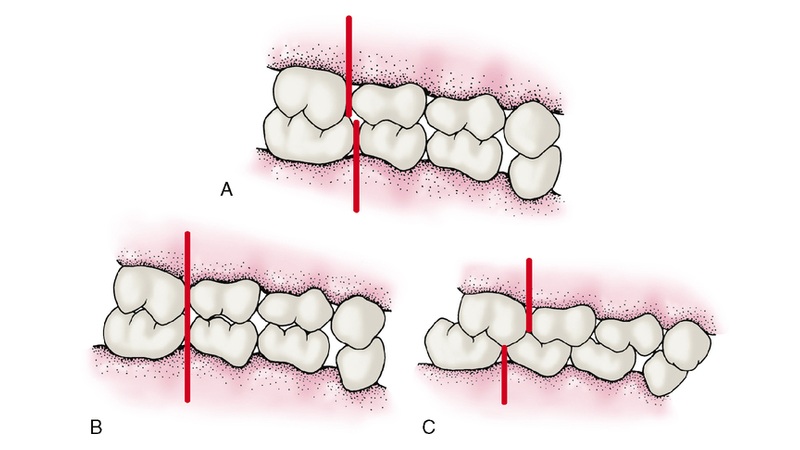 بهترین ایمپلنت اصفهان | بهترین دندانپزشک زیبایی اصفهان | دکتر مکانیک | بهترین دندانپزشک اصفهان | بهترین دندانپزشک کودکان اصفهان | تشخیص زودهنگام ناهنجاری‌های اکلوژن و مداخلات ساده