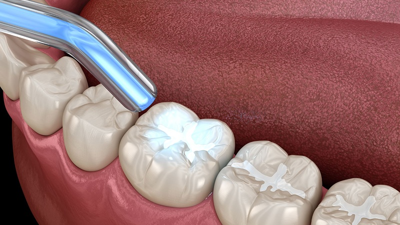 بهترین ایمپلنت اصفهان | بهترین دندانپزشک زیبایی اصفهان | دکتر مکانیک | بهترین دندانپزشک اصفهان | بهترین دندانپزشک کودکان اصفهان | مزایای ماده ترمیمی نانوکامپوزیت در دندانپزشکی