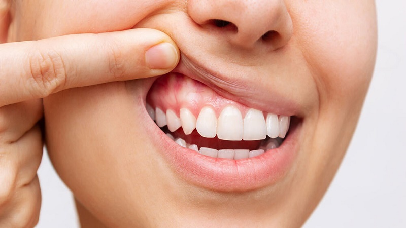 بهترین ایمپلنت اصفهان | بهترین دندانپزشک زیبایی اصفهان | دکتر مکانیک | بهترین دندانپزشک اصفهان | بهترین دندانپزشک کودکان اصفهان | آیا سفید شدن لثه بعد از ایمپلنت موقتی است؟