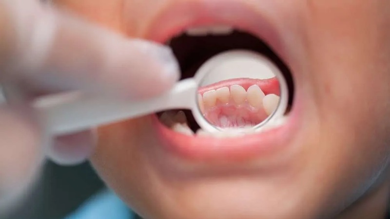 بیماری‌های شایع لثه کودکان و روش‌های پیشگیری و درمان آنها بهترین ایمپلنت اصفهان | بهترین دندانپزشک زیبایی اصفهان | دکتر مکانیک | بهترین دندانپزشک اصفهان | بهترین دندانپزشک کودکان اصفهان |