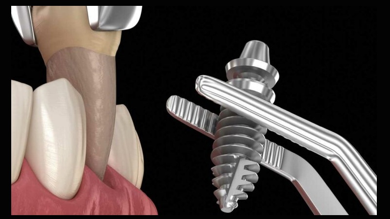 بهترین ایمپلنت اصفهان | بهترین دندانپزشک زیبایی اصفهان | دکتر مکانیک | بهترین دندانپزشک اصفهان | بهترین دندانپزشک کودکان اصفهان | ویژگی‌های کاندید مناسب برای کاشت ایمپلنت فوری