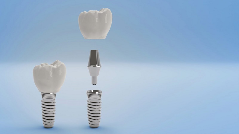 بهترین ایمپلنت اصفهان | بهترین دندانپزشک زیبایی اصفهان | دکتر ندا مکانیک | پاسخ به سوالات متداول ایمپلنت دندان