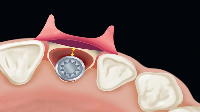 بهترین ایمپلنت اصفهان | بهترین دندانپزشک زیبایی اصفهان | دندانپزشک اصفهان| دندانپزشک کودکان اصفهان | اهمیت حیاتی استخوان باکال در پایداری ایمپلنت