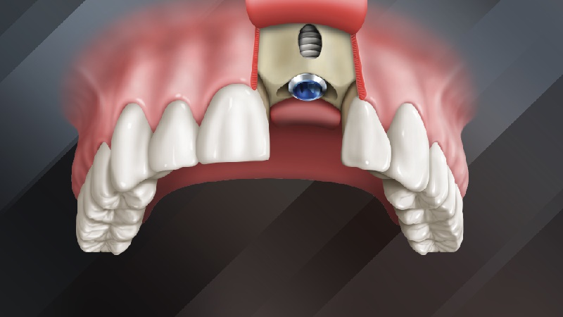 بهترین ایمپلنت اصفهان | بهترین دندانپزشک زیبایی اصفهان | دندانپزشک اصفهان| دندانپزشک کودکان اصفهان | اهمیت حیاتی استخوان باکال در پایداری ایمپلنت