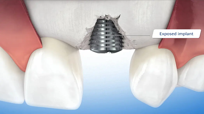بهترین ایمپلنت اصفهان | بهترین دندانپزشک زیبایی اصفهان | دندانپزشک اصفهان| دندانپزشک کودکان اصفهان | . اهمیت حیاتی استخوان باکال در پایداری ایمپلنت