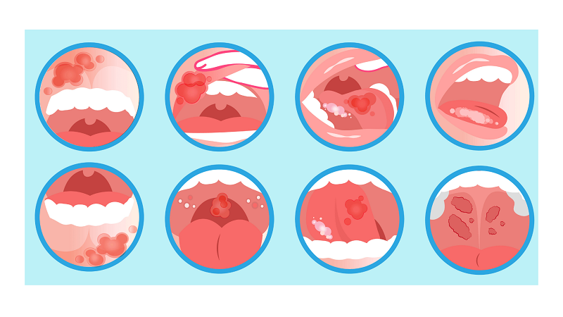 بهترین ایمپلنت اصفهان | بهترین دندانپزشک زیبایی اصفهان | دندانپزشک اصفهان| دندانپزشک کودکان اصفهان |. عمده ترین علل بروز لکوپلاکیا روی لثه ها