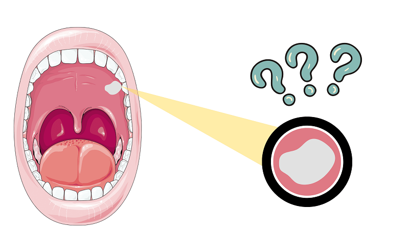 بهترین ایمپلنت اصفهان | بهترین دندانپزشک زیبایی اصفهان | دندانپزشک اصفهان| دندانپزشک کودکان اصفهان | عمده ترین علل بروز لکوپلاکیا روی لثه ها