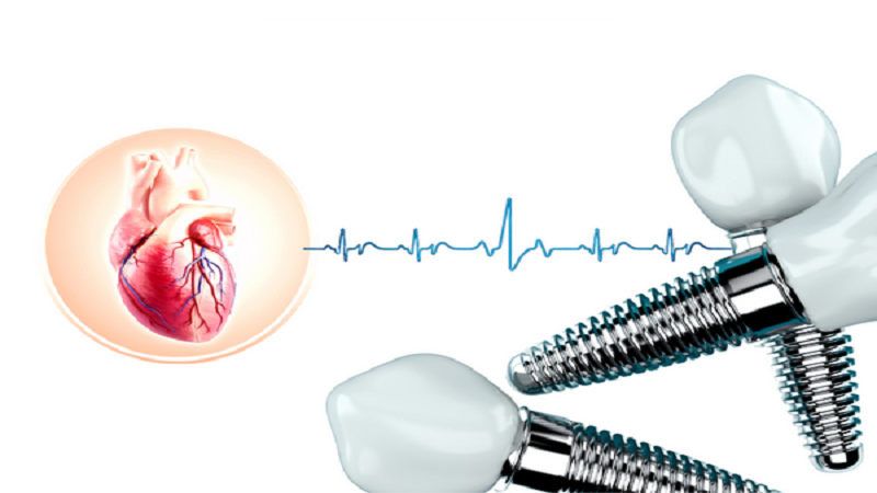 بهترین ایمپلنت اصفهان | بهترین دندانپزشک زیبایی اصفهان | بهترین دندانپزشک اصفهان | بهترین دندانپزشک کودکان اصفهان | چه نوع ایمپلنتی برای بیماران قلبی کم‌خطرتر است؟