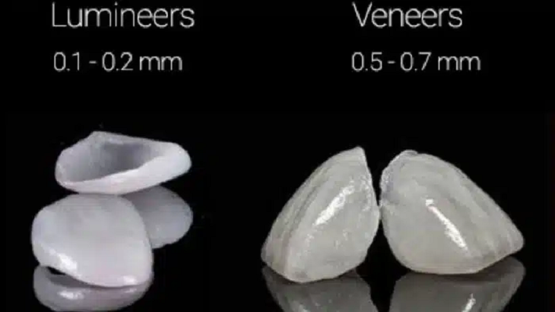 بهترین ایمپلنت اصفهان | بهترین دندانپزشک زیبایی اصفهان | بهترین دندانپزشک اصفهان | بهترین دندانپزشک کودکان اصفهان | . بررسی شباهتها و تفاوتهای لمینت معمولی و لومینیرز