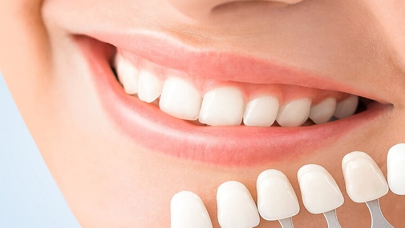 بهترین ایمپلنت اصفهان | بهترین دندانپزشک زیبایی اصفهان | بهترین دندانپزشک اصفهان | بهترین دندانپزشک کودکان اصفهان | بررسی شباهتها و تفاوتهای لمینت معمولی و لومینیرز