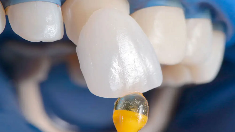 بهترین ایمپلنت اصفهان | بهترین دندانپزشک زیبایی اصفهان | بهترین دندانپزشک اصفهان | بهترین دندانپزشک کودکان اصفهان | بررسی شباهتها و تفاوتهای لمینت معمولی و لومینیرز