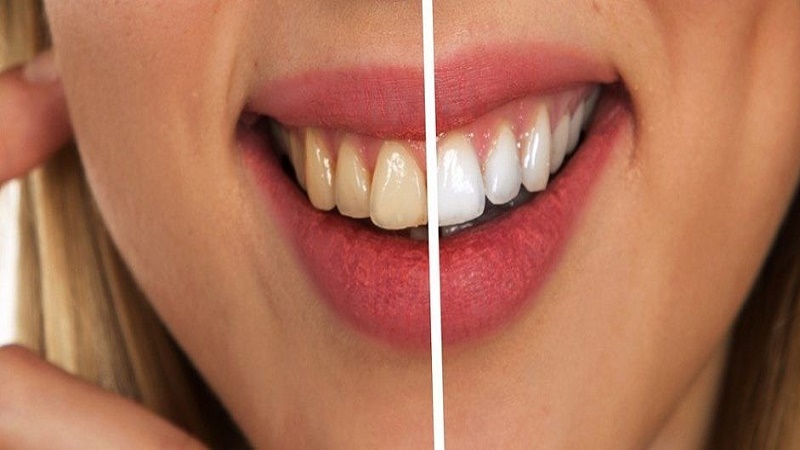 بهترین ایمپلنت اصفهان | بهترین دندانپزشک زیبایی اصفهان | بهترین دندانپزشک اصفهان | بهترین دندانپزشک کودکان اصفهان | . تغییر رنگ و زرد شدن دندان ها .