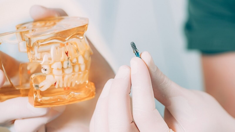 بهترین ایمپلنت اصفهان | بهترین دندانپزشک زیبایی اصفهان | بهترین دندانپزشک اصفهان | بهترین دندانپزشک کودکان اصفهان | درد بعد از گذاشتن پیچ ایمپلنت .