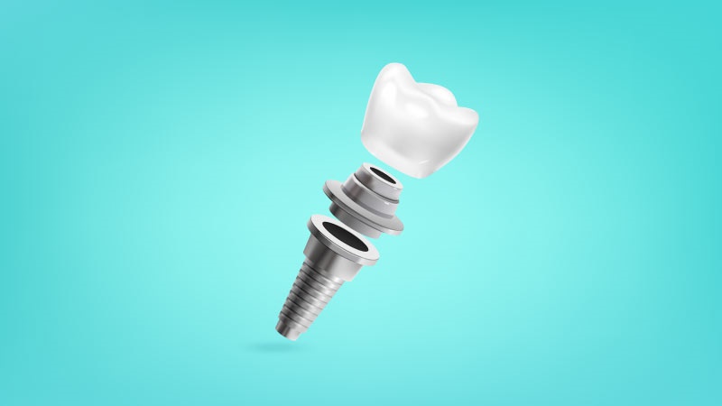 بهترین ایمپلنت اصفهان | بهترین دندانپزشک زیبایی اصفهان | بهترین دندانپزشک اصفهان | بهترین دندانپزشک کودکان اصفهان |.. درد بعد از گذاشتن پیچ ایمپلنت