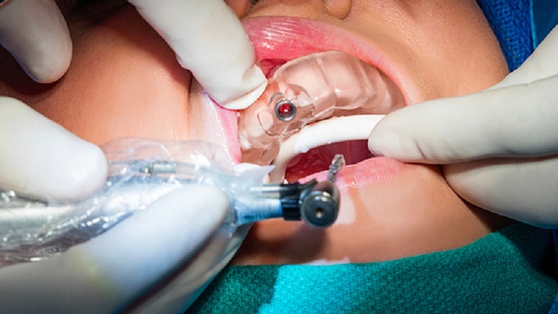 بهترین ایمپلنت اصفهان | بهترین دندانپزشک زیبایی اصفهان | بهترین دندانپزشک اصفهان | بهترین دندانپزشک کودکان اصفهان | درد بعد از گذاشتن پیچ ایمپلنت